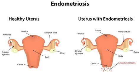 Can an X-ray Show Endometriosis?